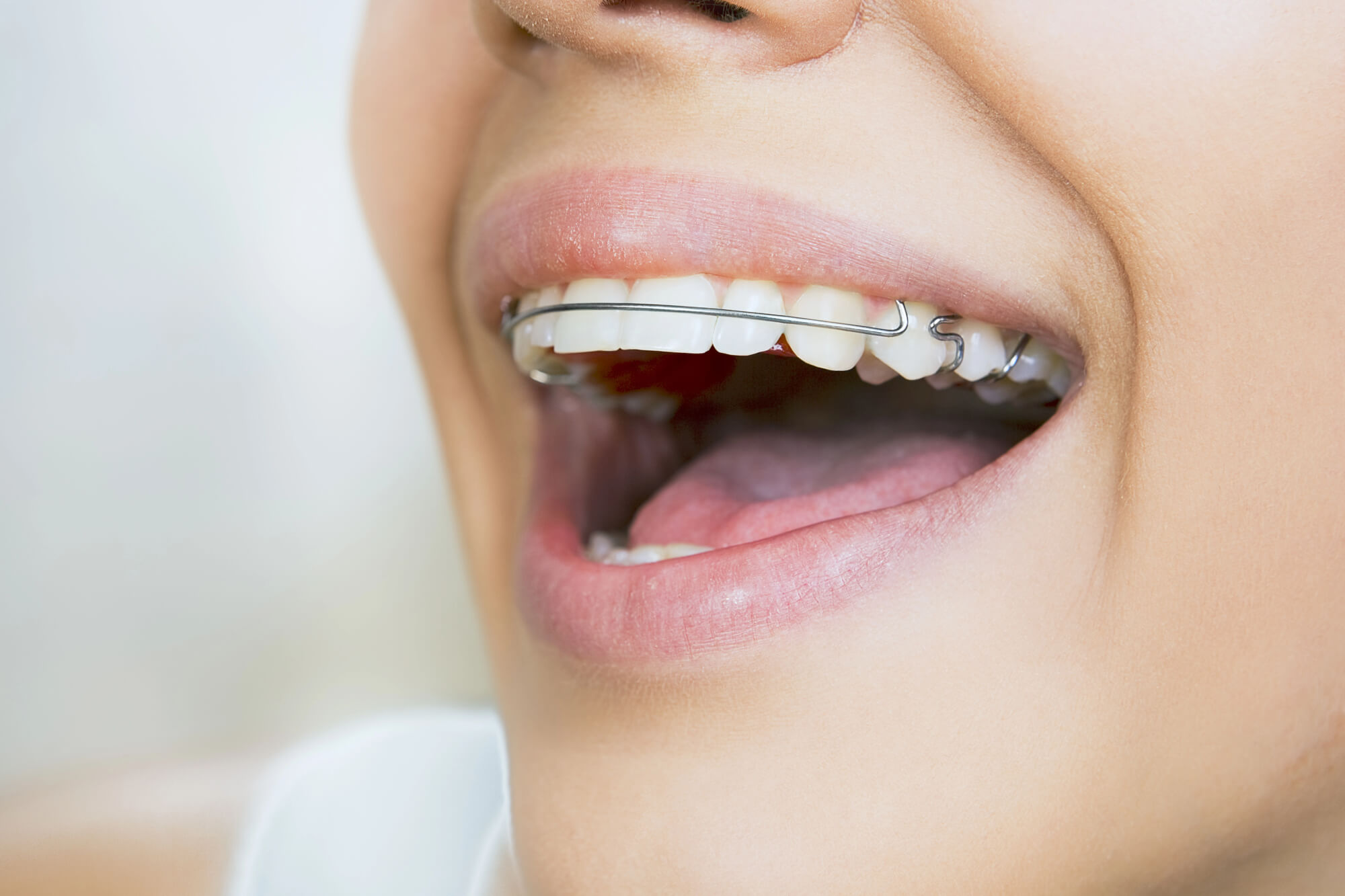 Fixed Retainers After Braces in Franklin TN
