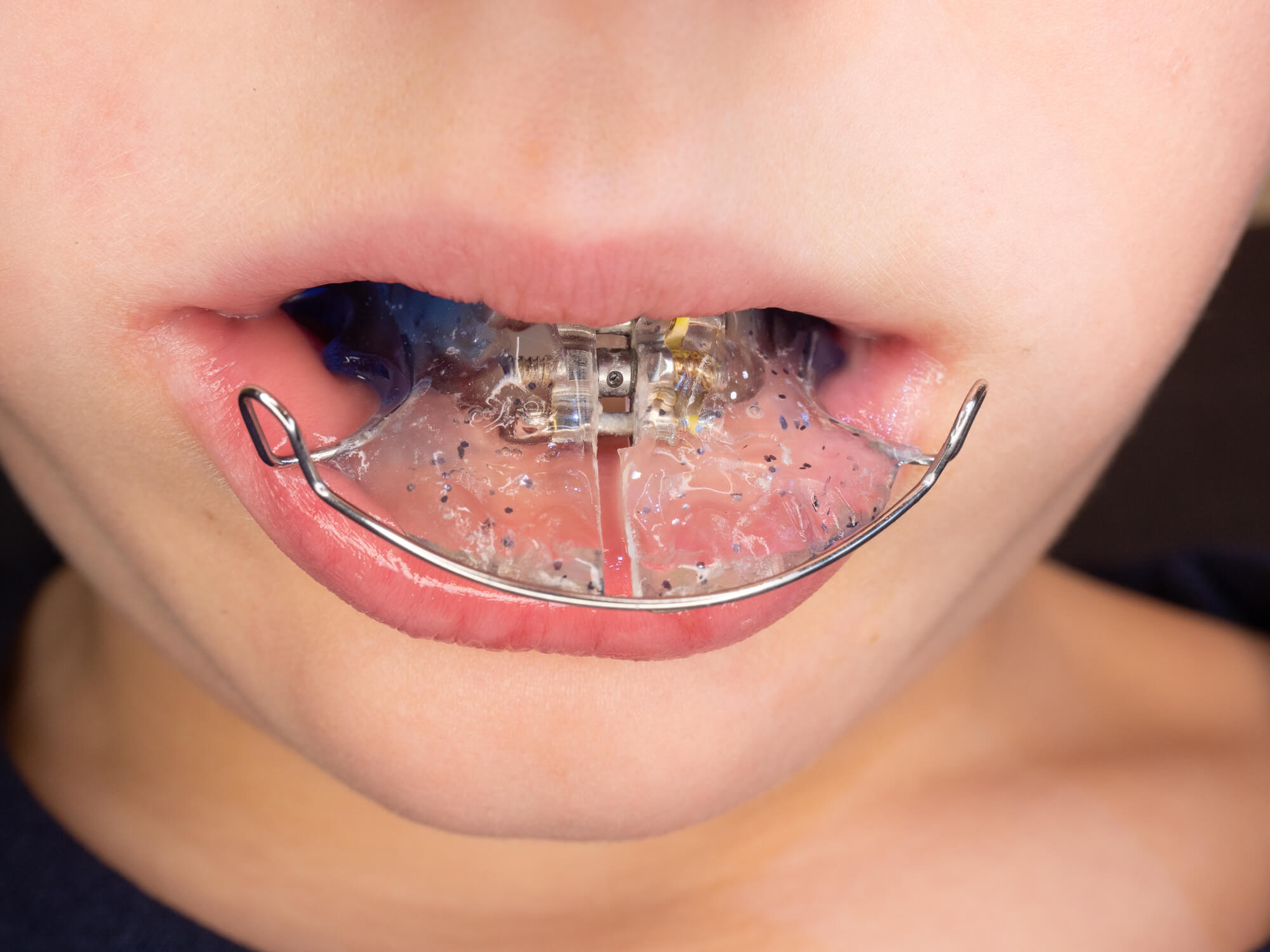 Kid with Retainers After Braces in Franklin TN