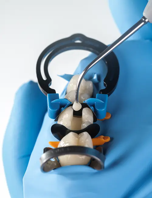 Close-up of dental procedure showing molar teeth isolated with rubber dam and clamps, with a dental tool applying a white dental material on a tooth surface, held by a gloved hand.