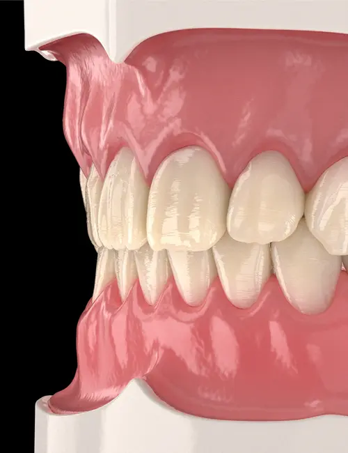 3D illustration of human teeth and gums from a side view showing upper and lower teeth in occlusion within gums and jawbone structure.