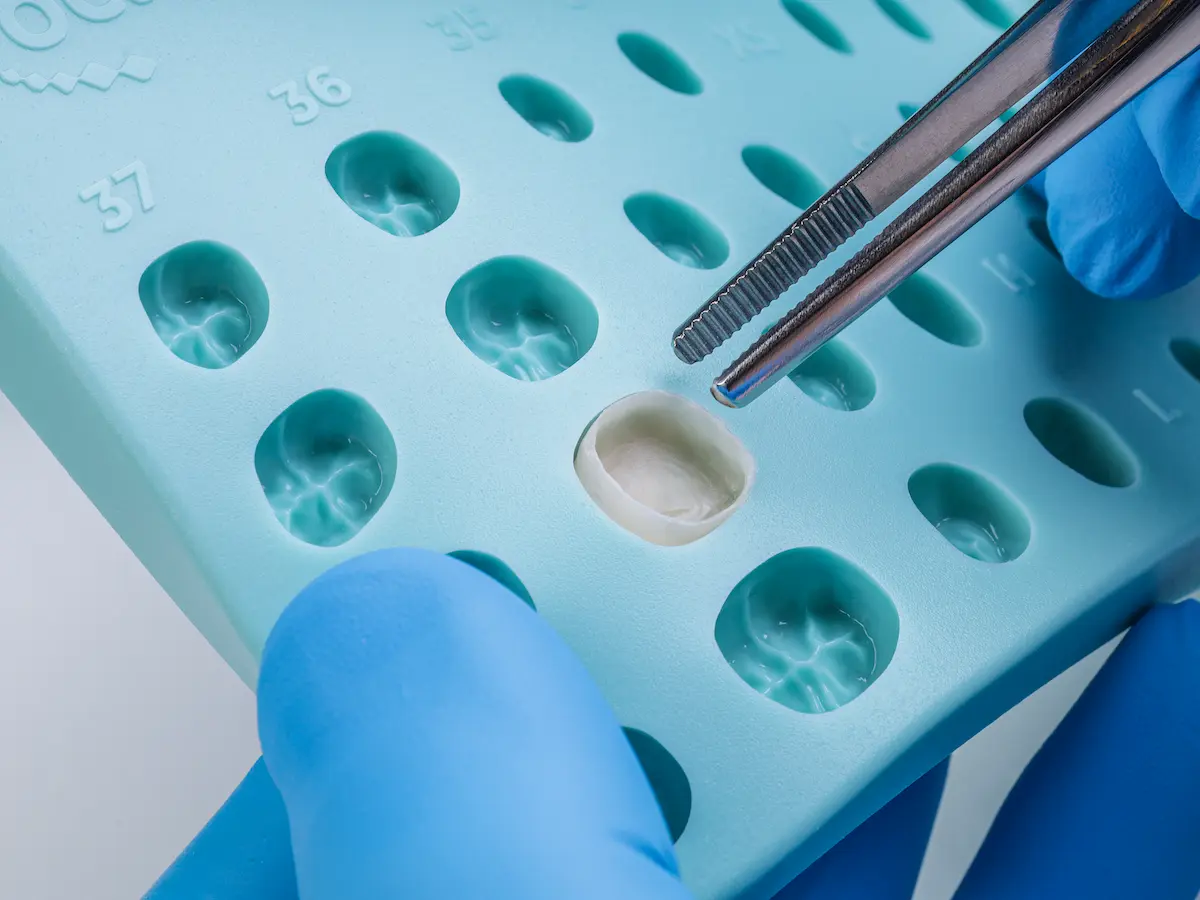 Gloved hand holding dental tweezers placing a tooth-shaped dental veneer into a mold tray with numbered slots.