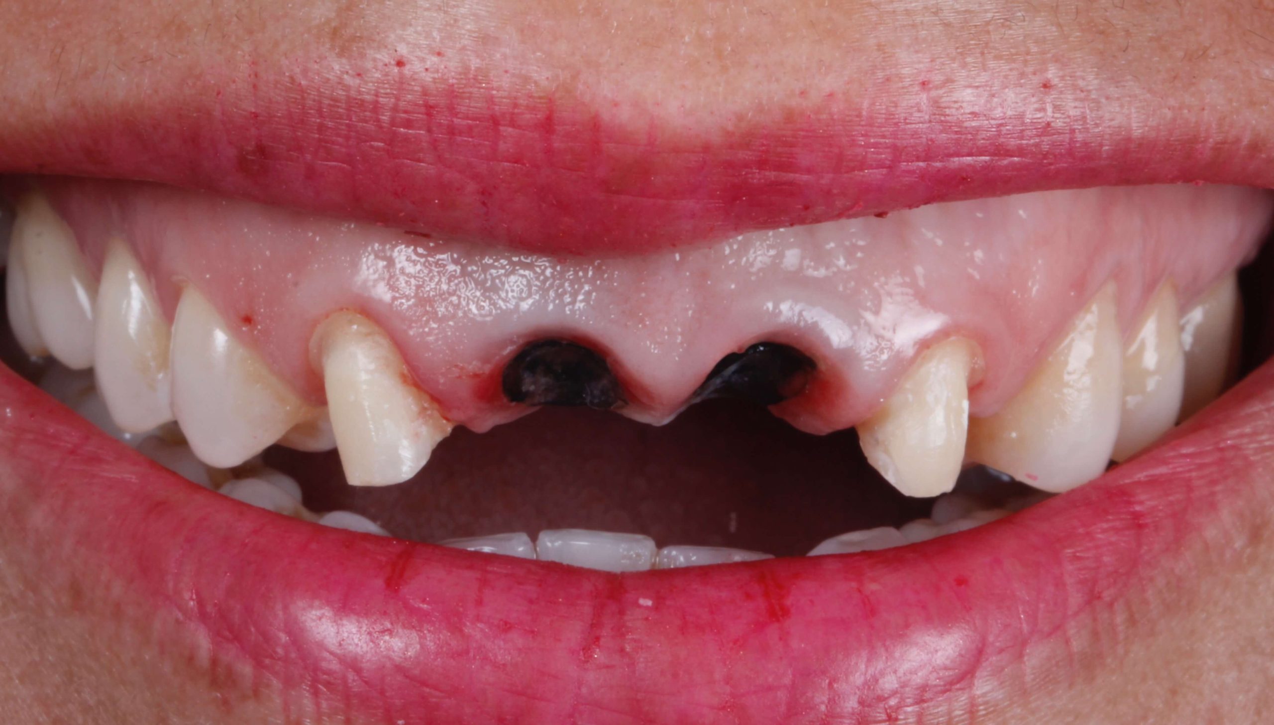 Dental Implants Cosmetic Dentistry Toronto