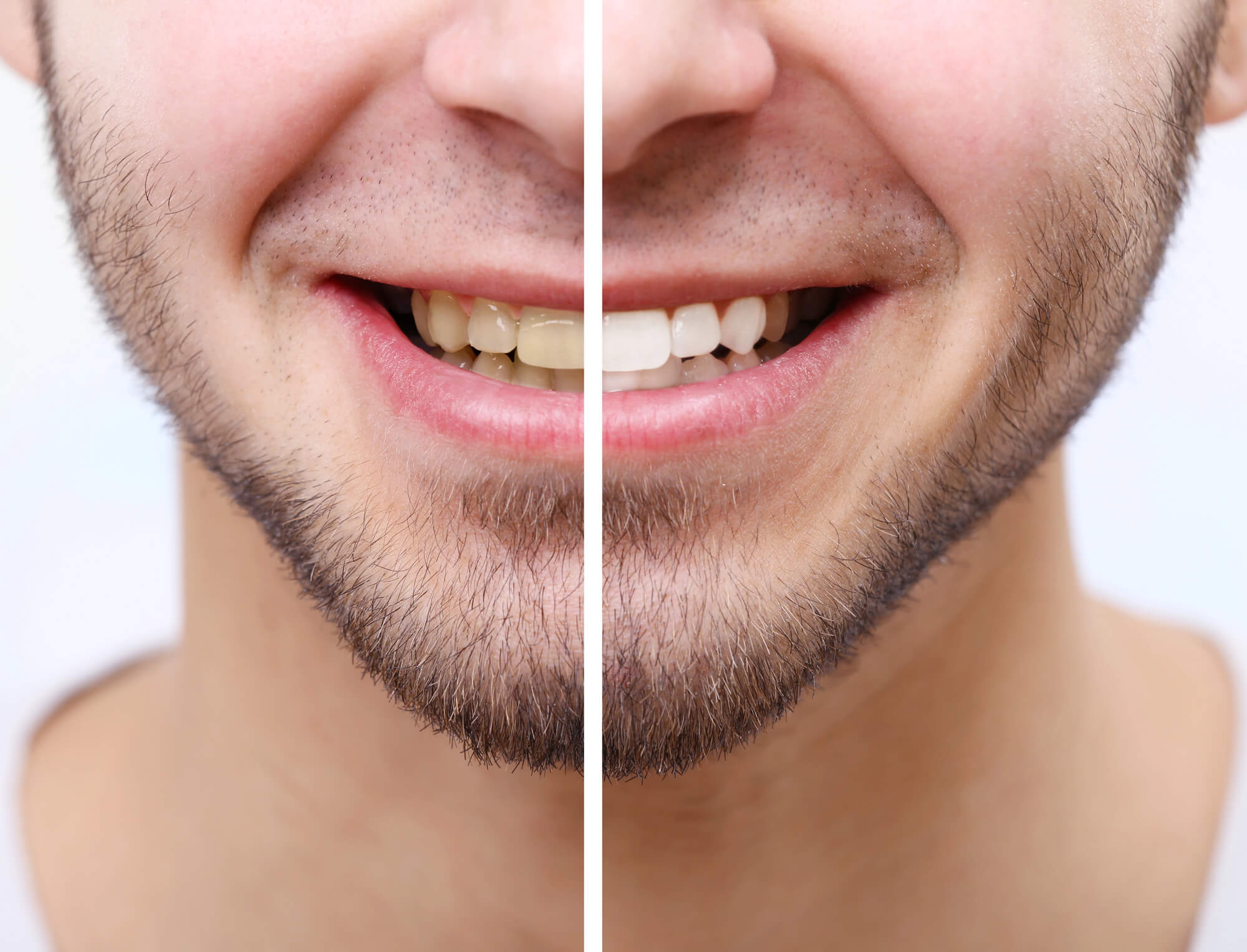 before and after seeing acosmetic dentist north tampa