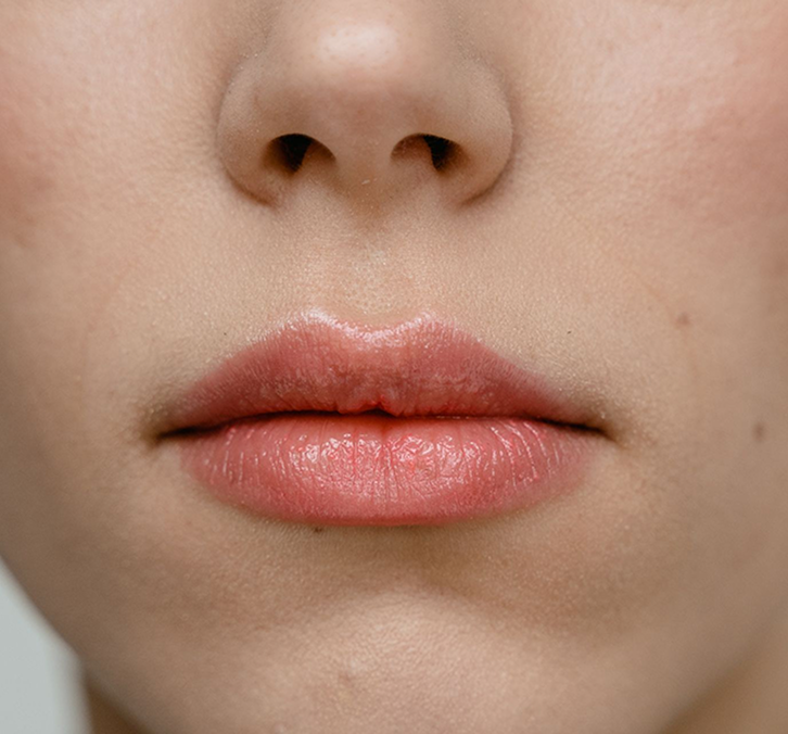 Natural-looking lip filler results at True Medical Spa in Draper, Utah
