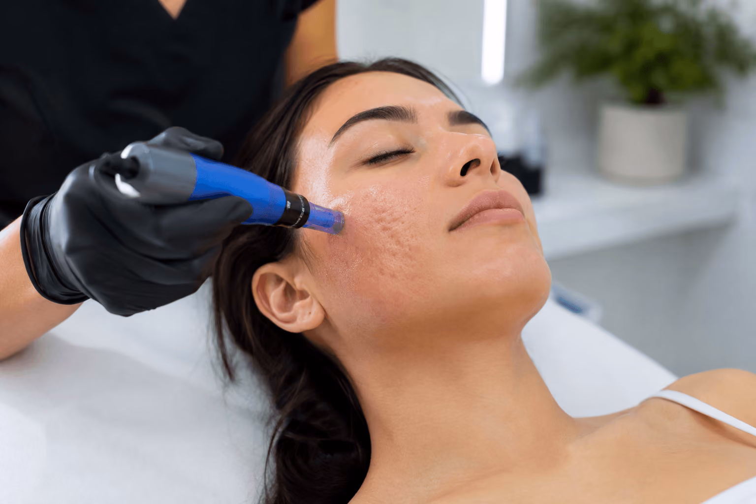 Provider performing SkinPen treatment for acne scars in Draper, Utah medical spa clinic