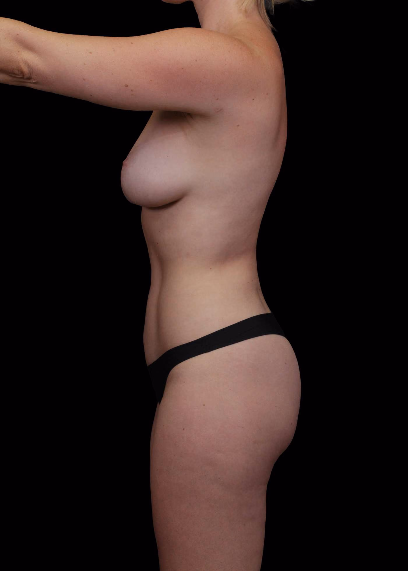 Circumferential Liposuction Case 132