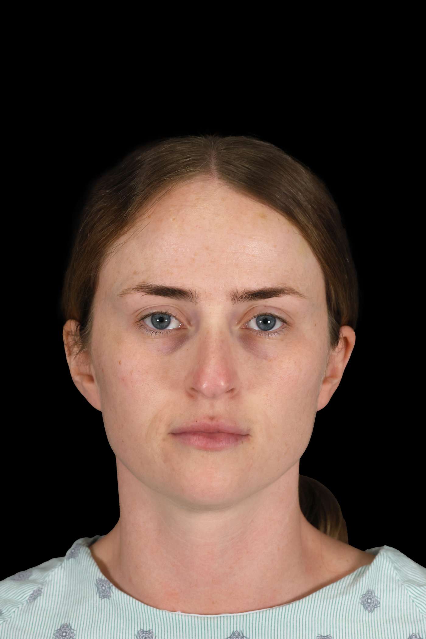 Rhinoplasty Case 153