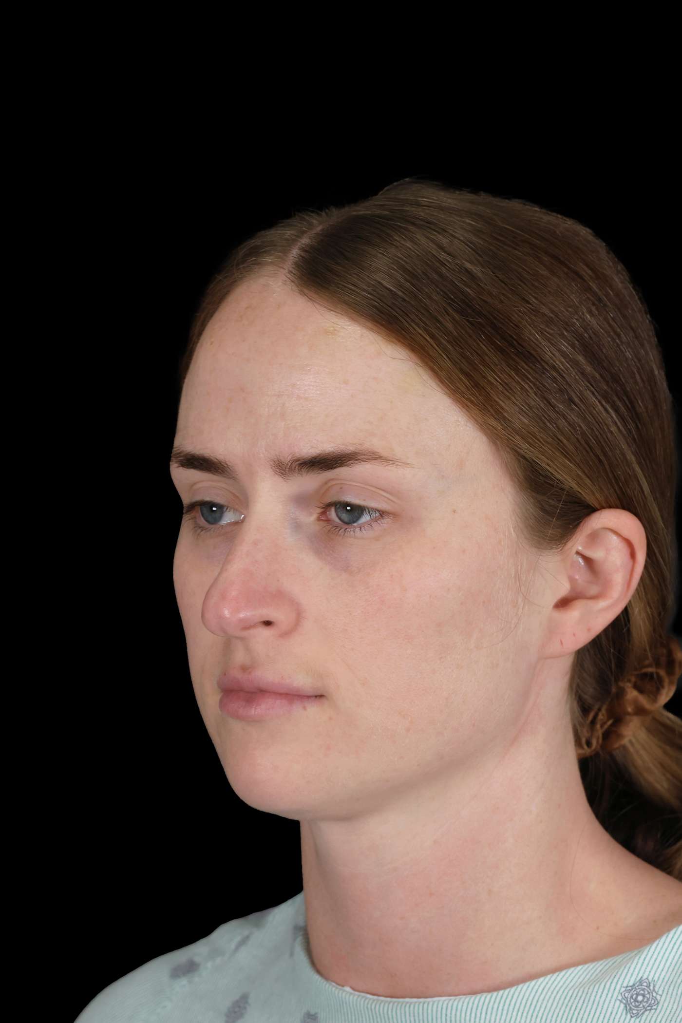 Rhinoplasty Case 153
