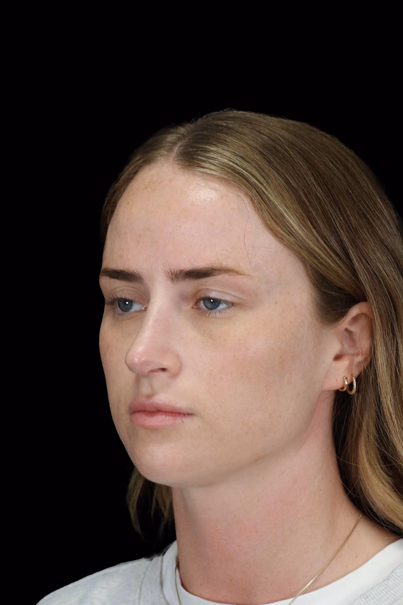 Rhinoplasty Case 153