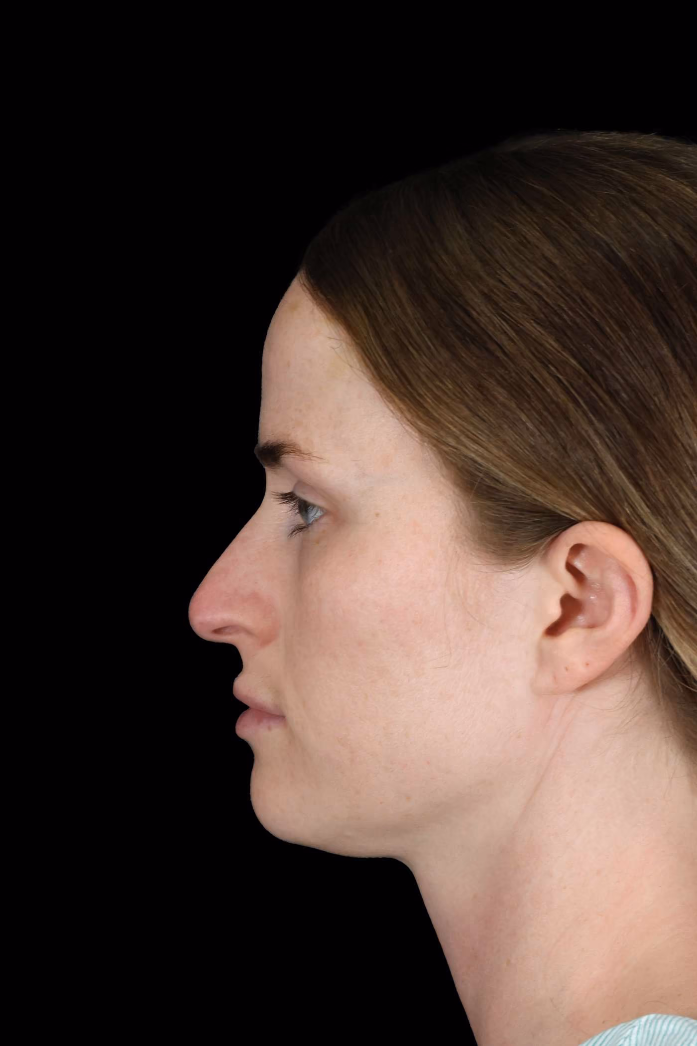 Rhinoplasty Case 153