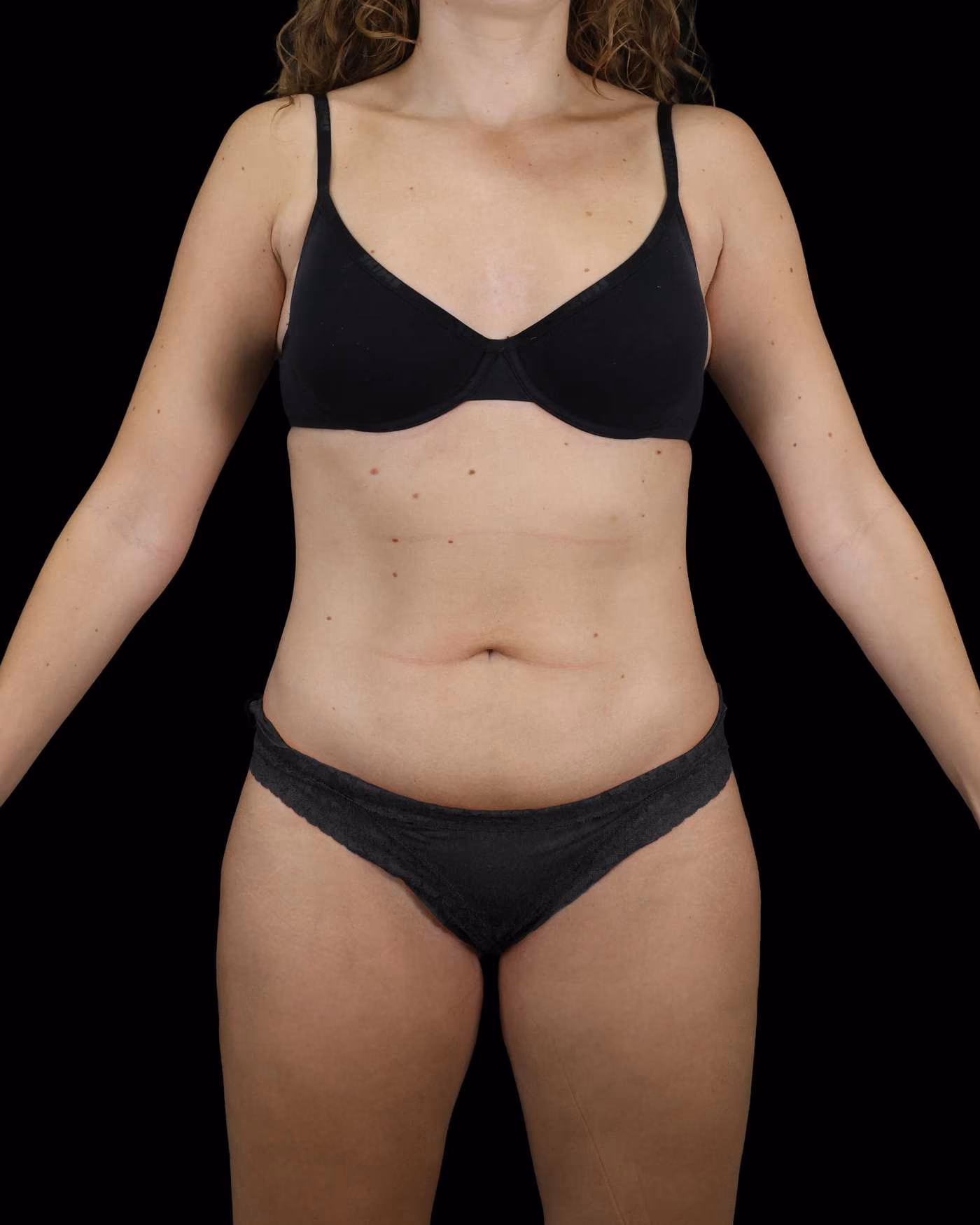 Circumferential Liposuction Case 190