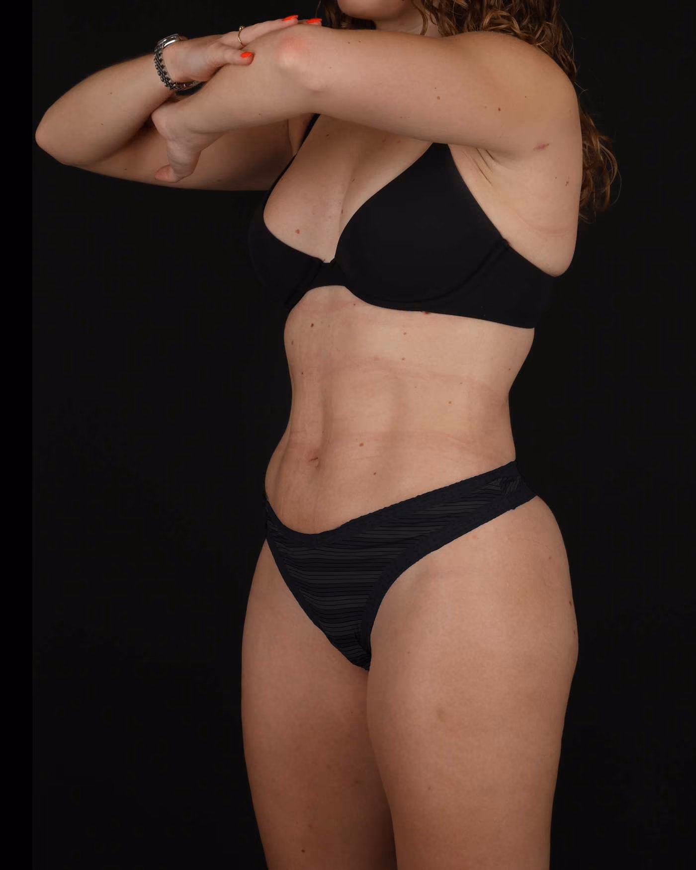 Circumferential Liposuction Case 190