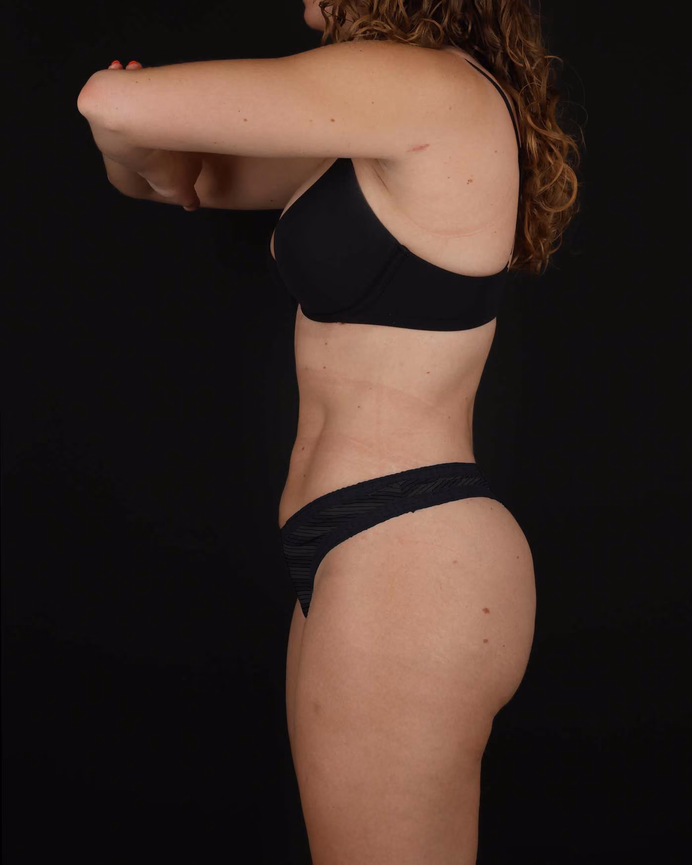 Circumferential Liposuction Case 190