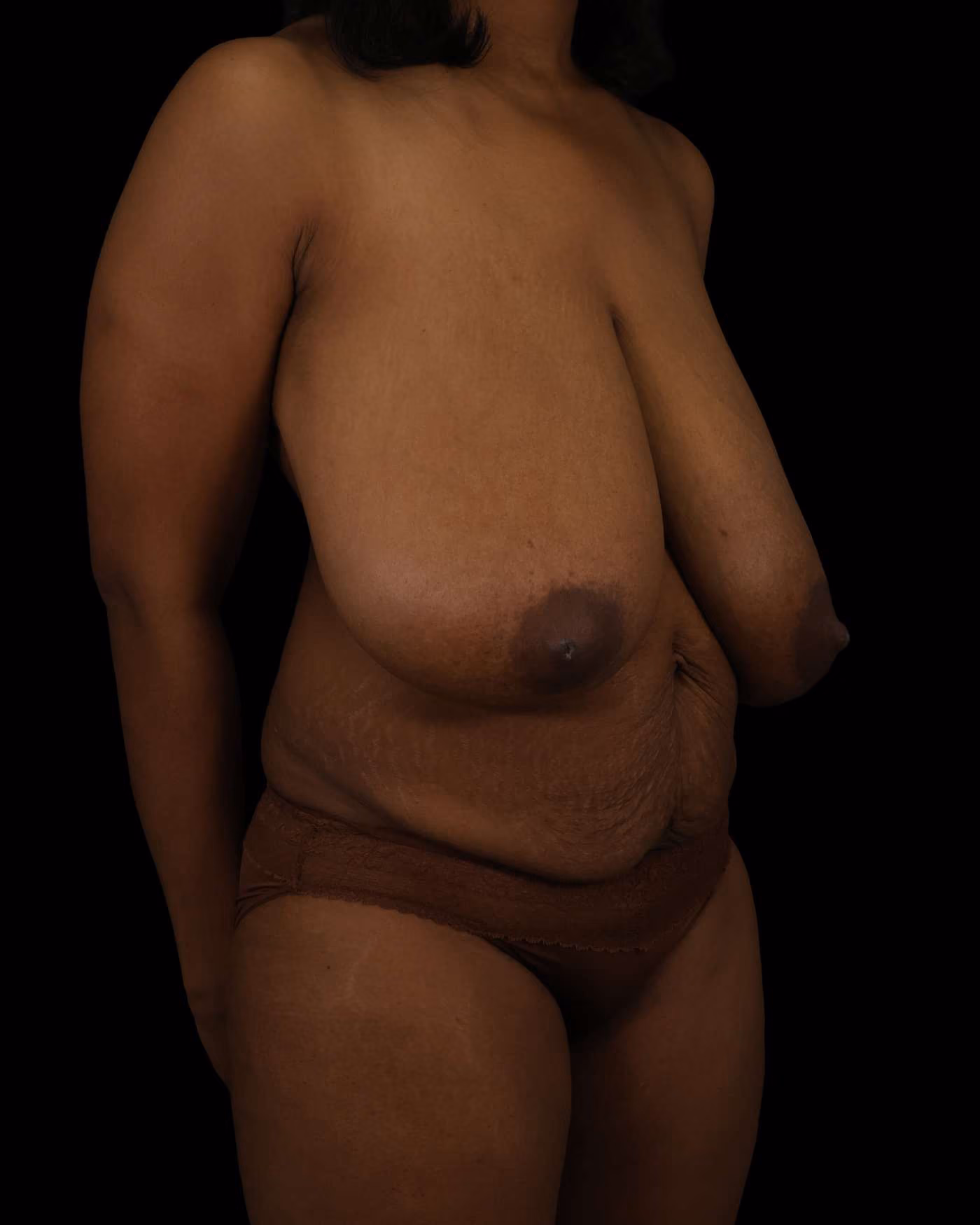 Abdominoplasty Case 209