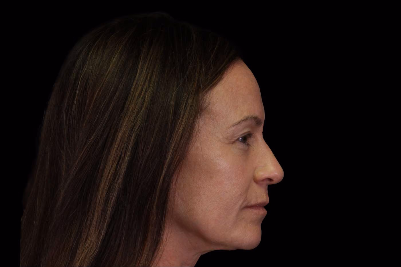 Upper Blepharoplasty Case 111