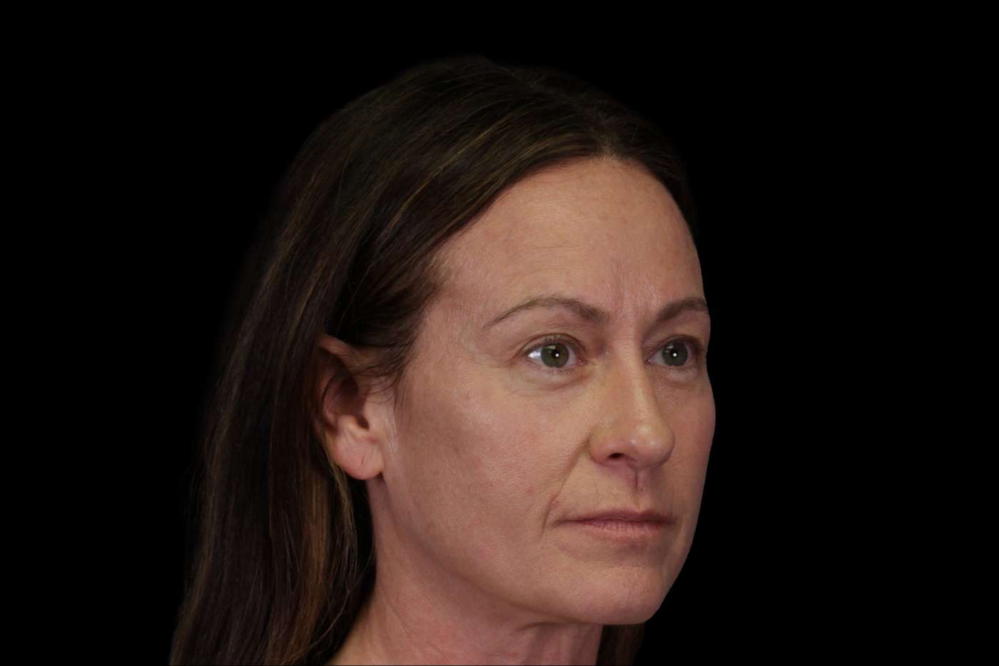 Upper Blepharoplasty Case 111