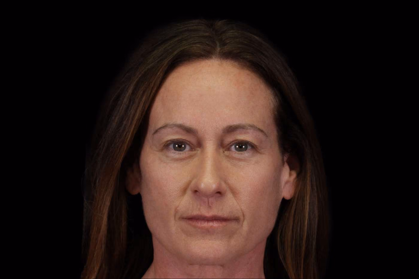 Upper Blepharoplasty Case 111