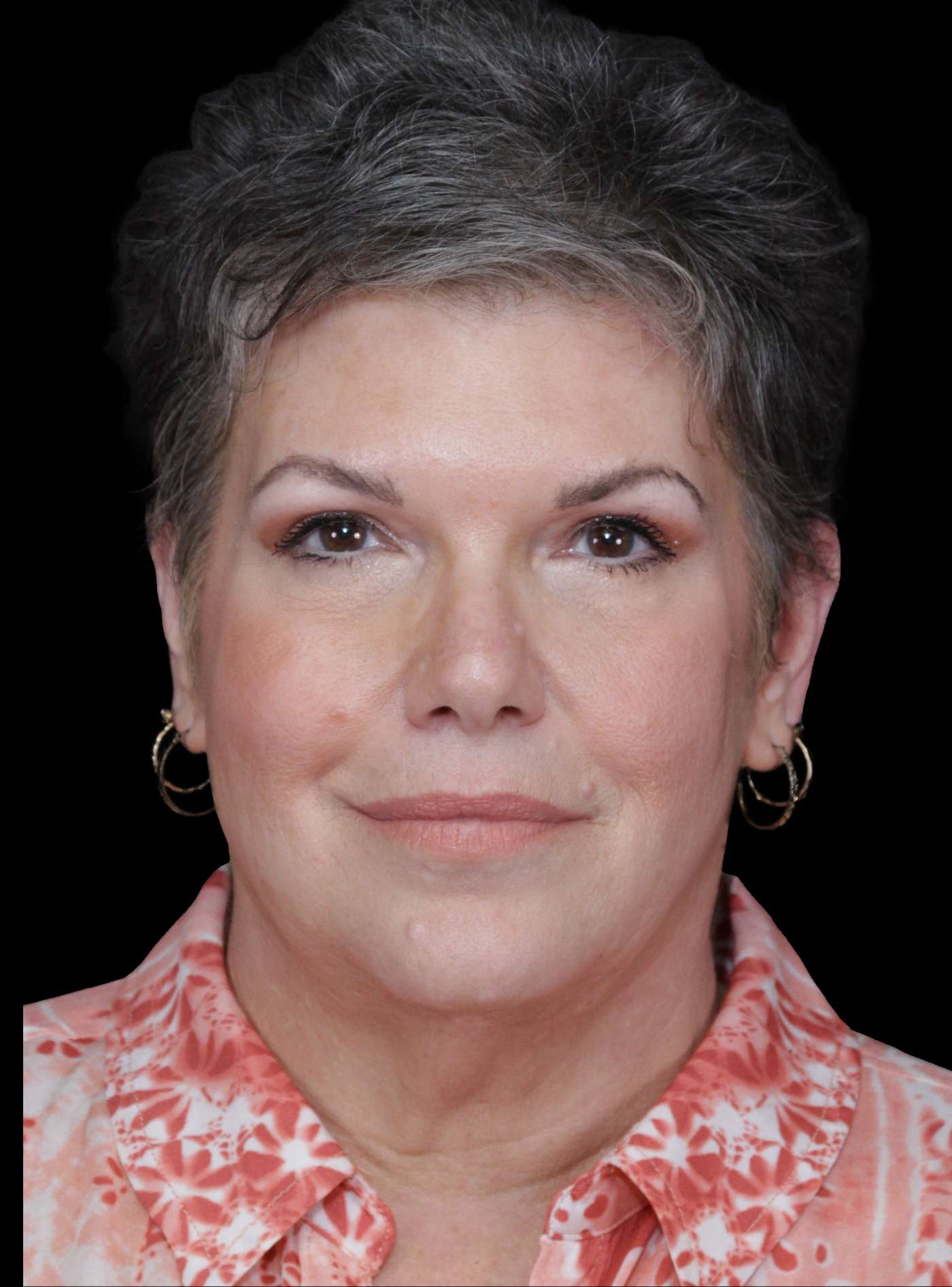Upper Blepharoplasty Case 58