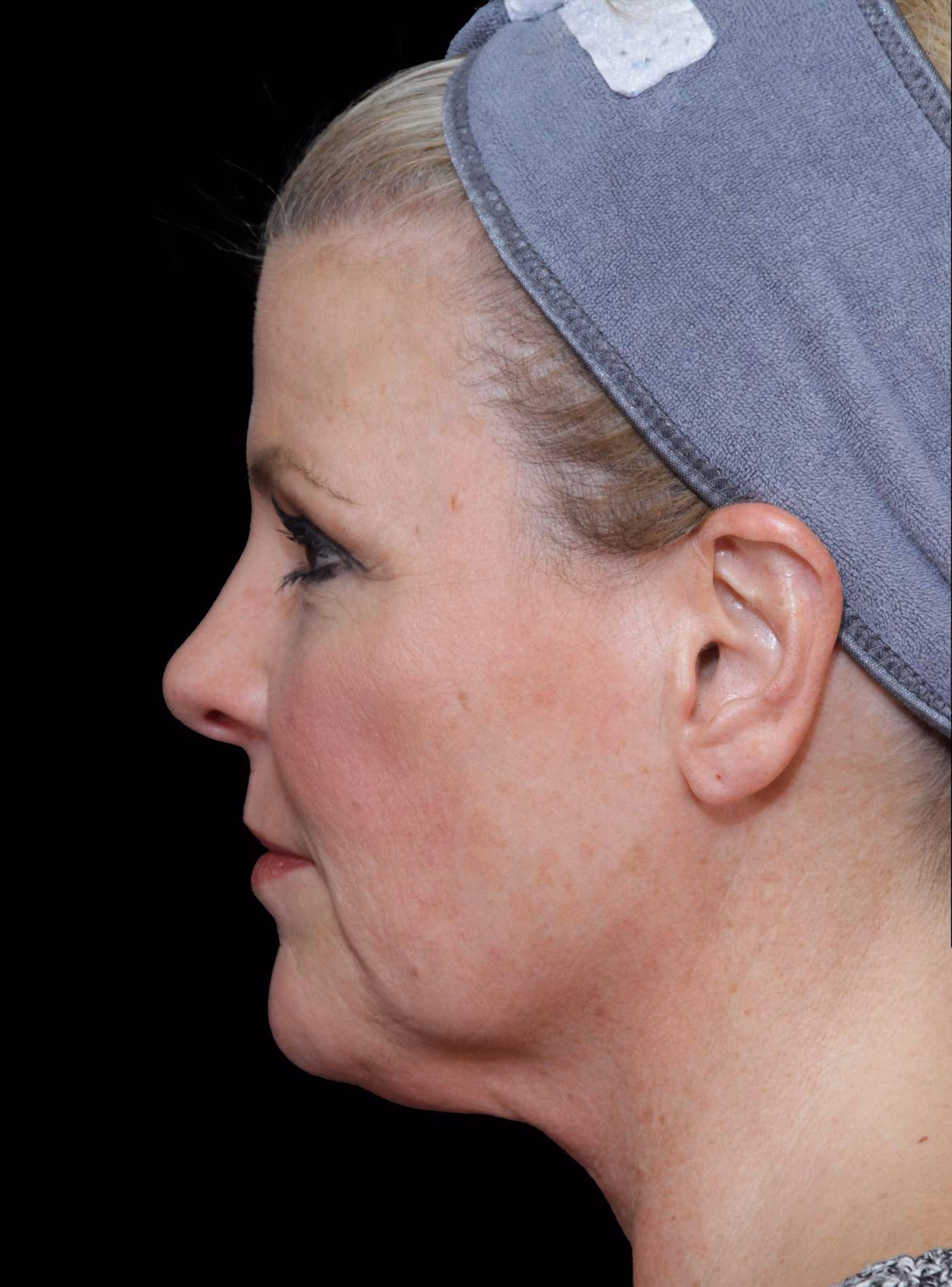 Blepharoplasty Case 028
