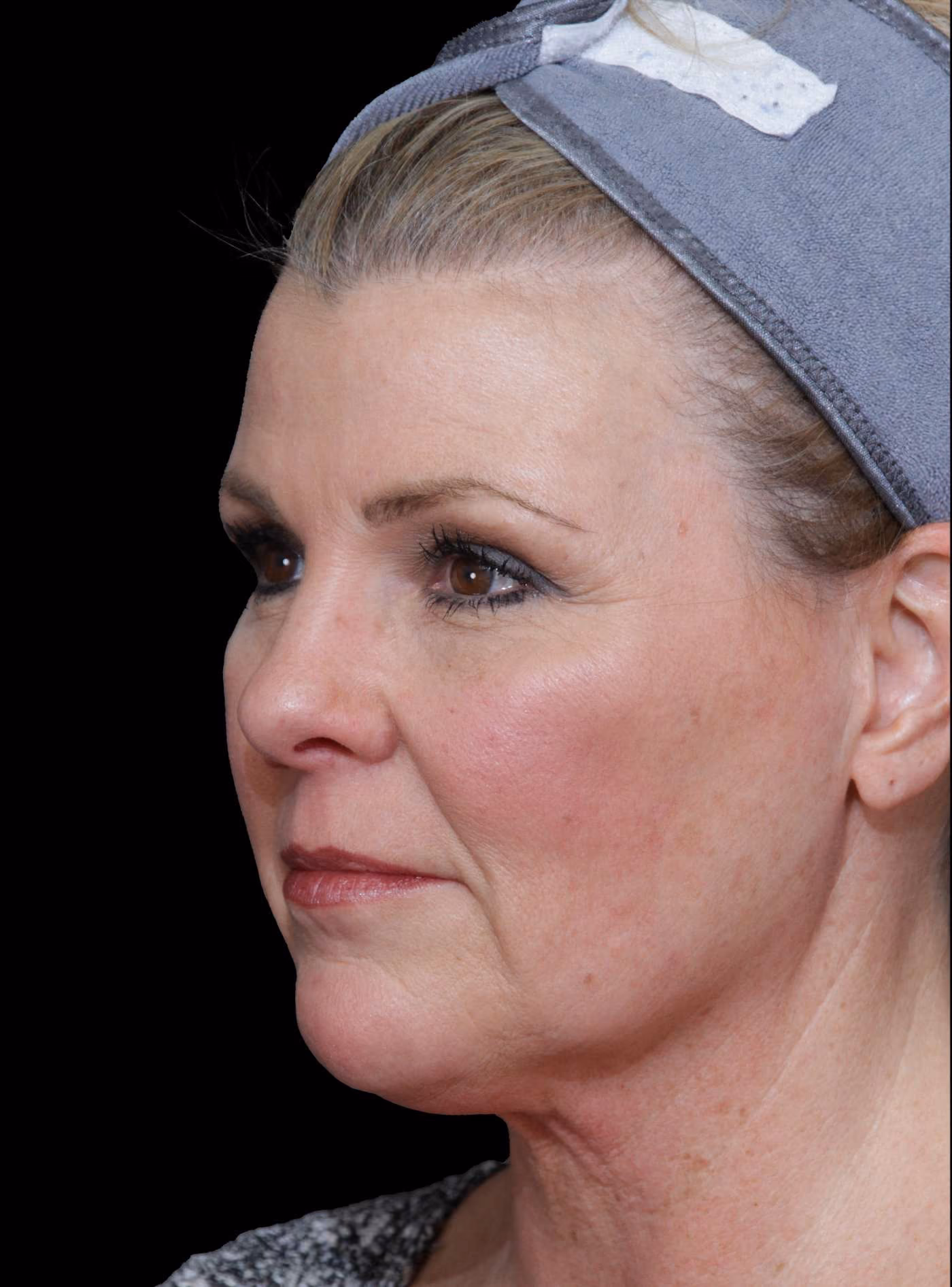 Blepharoplasty Case 028