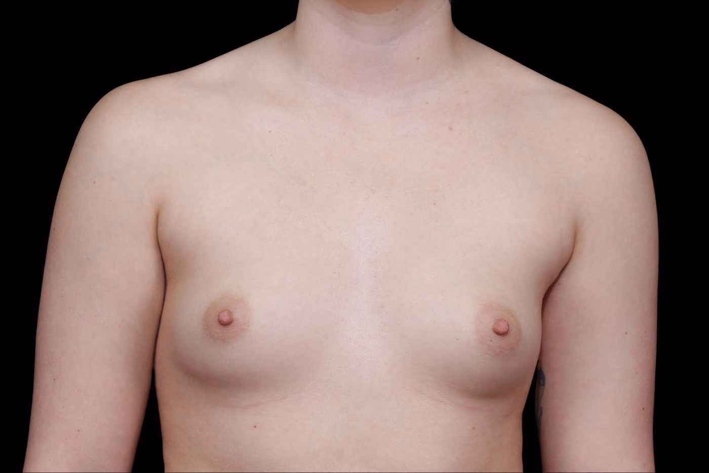 Breast Augmentation Case 33