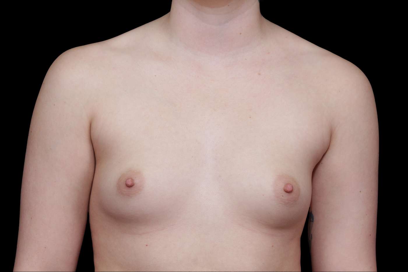 Breast Augmentation Case 33