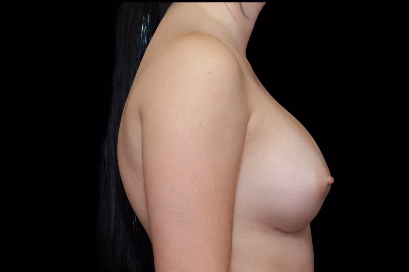 Breast Augmentation Case 33