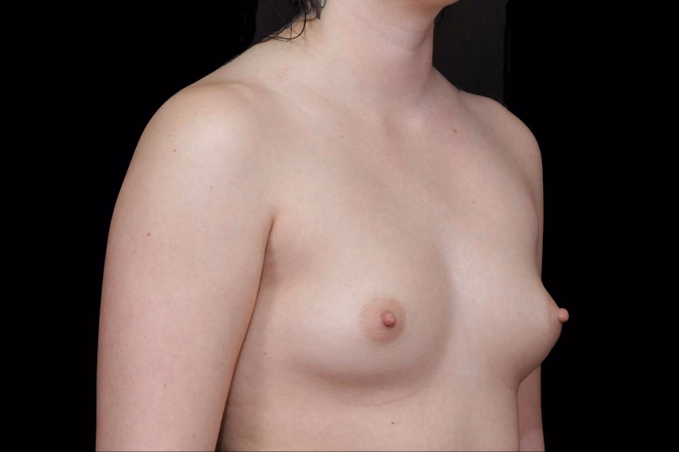 Breast Augmentation Case 33