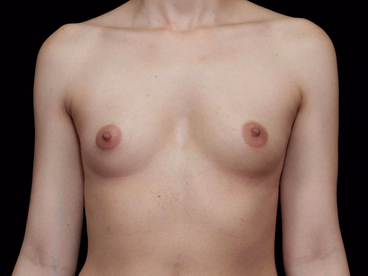 Breast Augmentation Case 39
