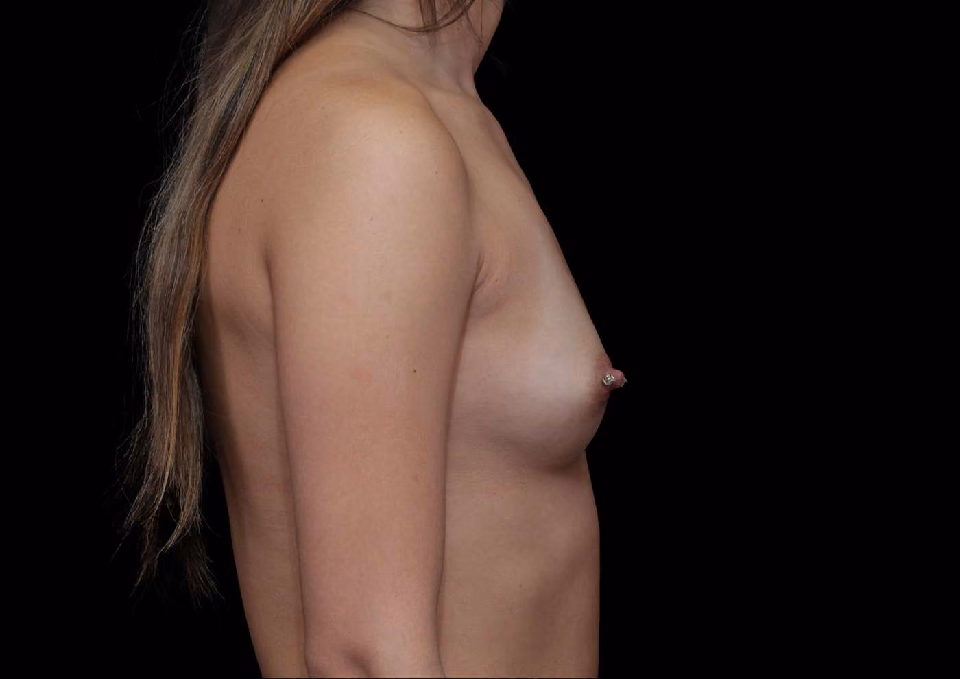 Breast Augmentation Case 40