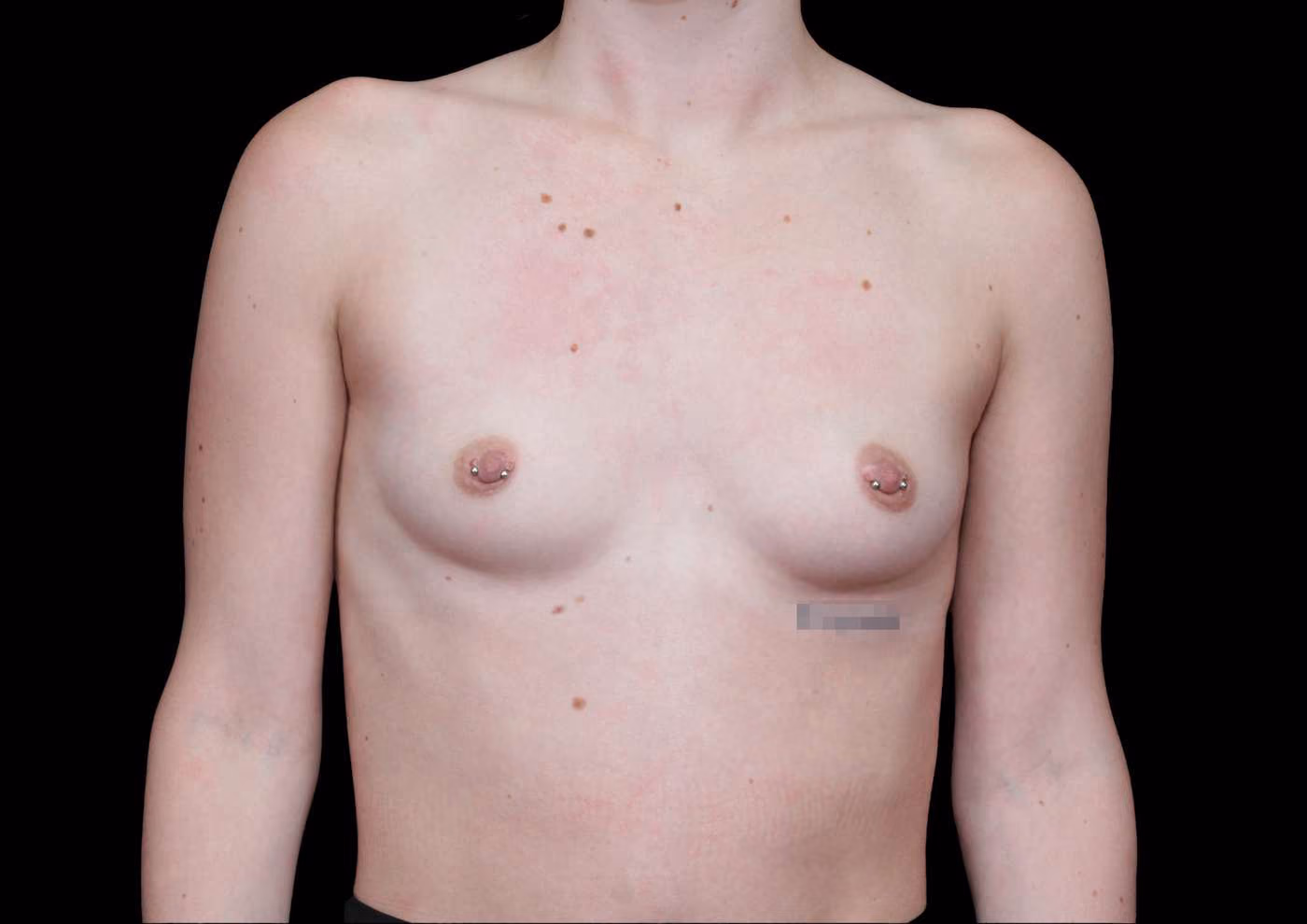 Breast Augmentation Case 64