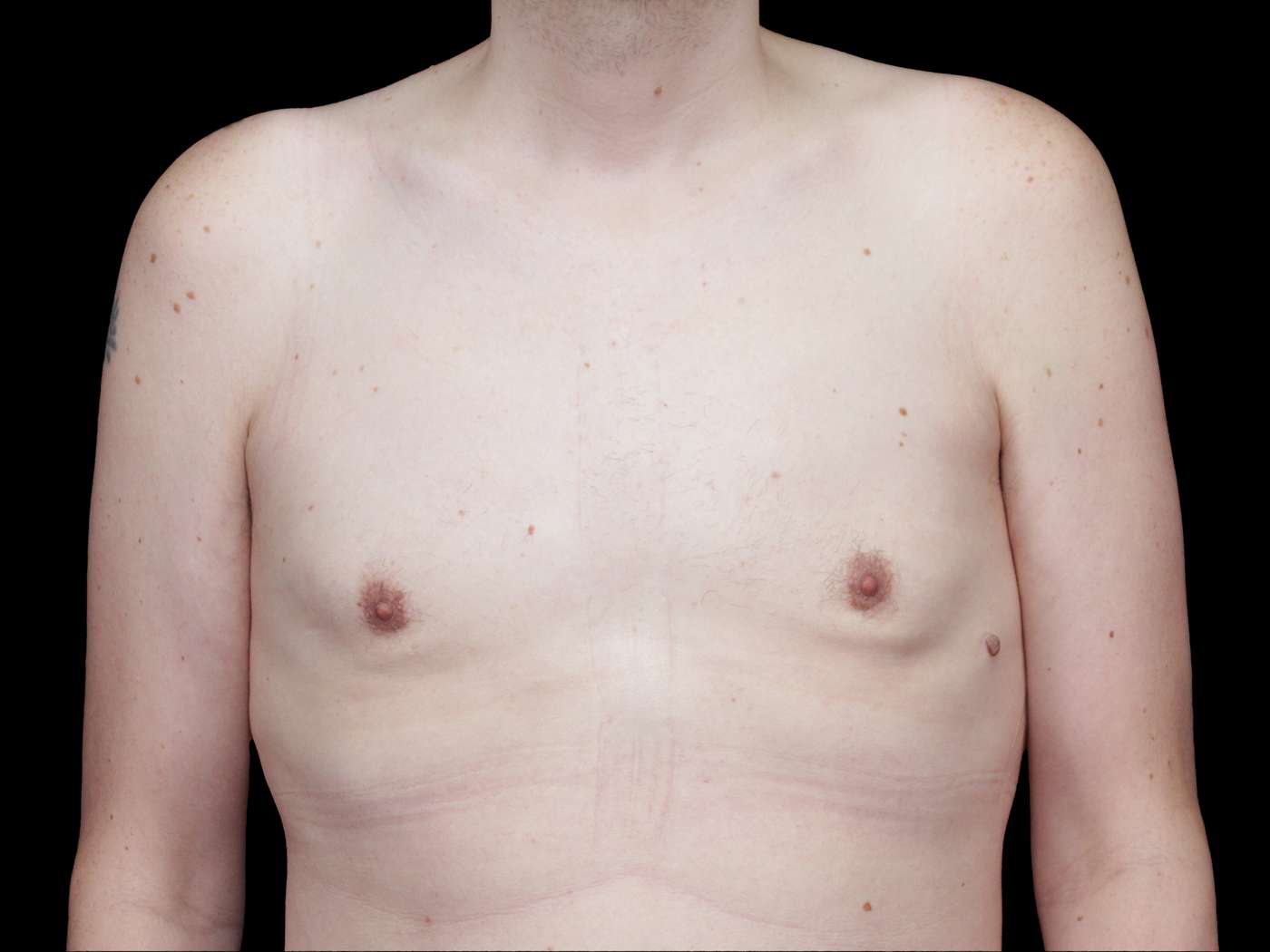 Gynecomastia Case 69