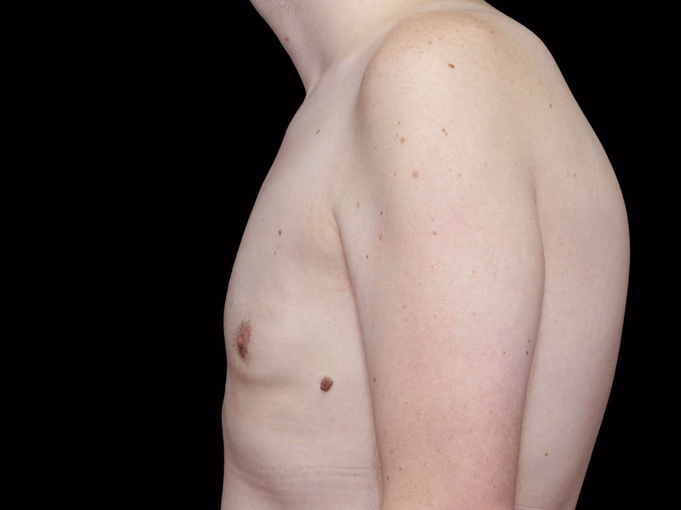Gynecomastia Case 69