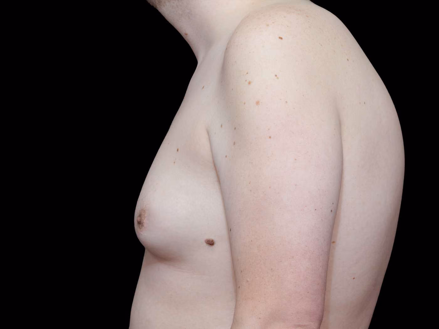 Gynecomastia Case 69