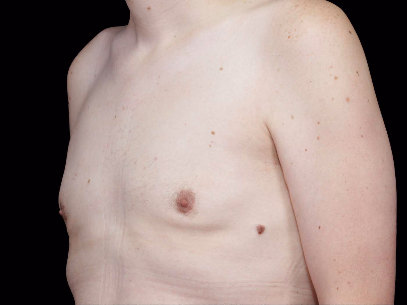 Gynecomastia Case 69