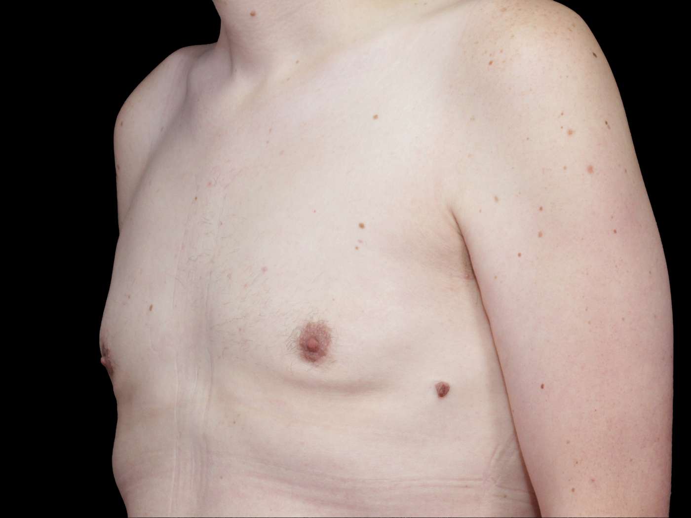 Gynecomastia Case 69