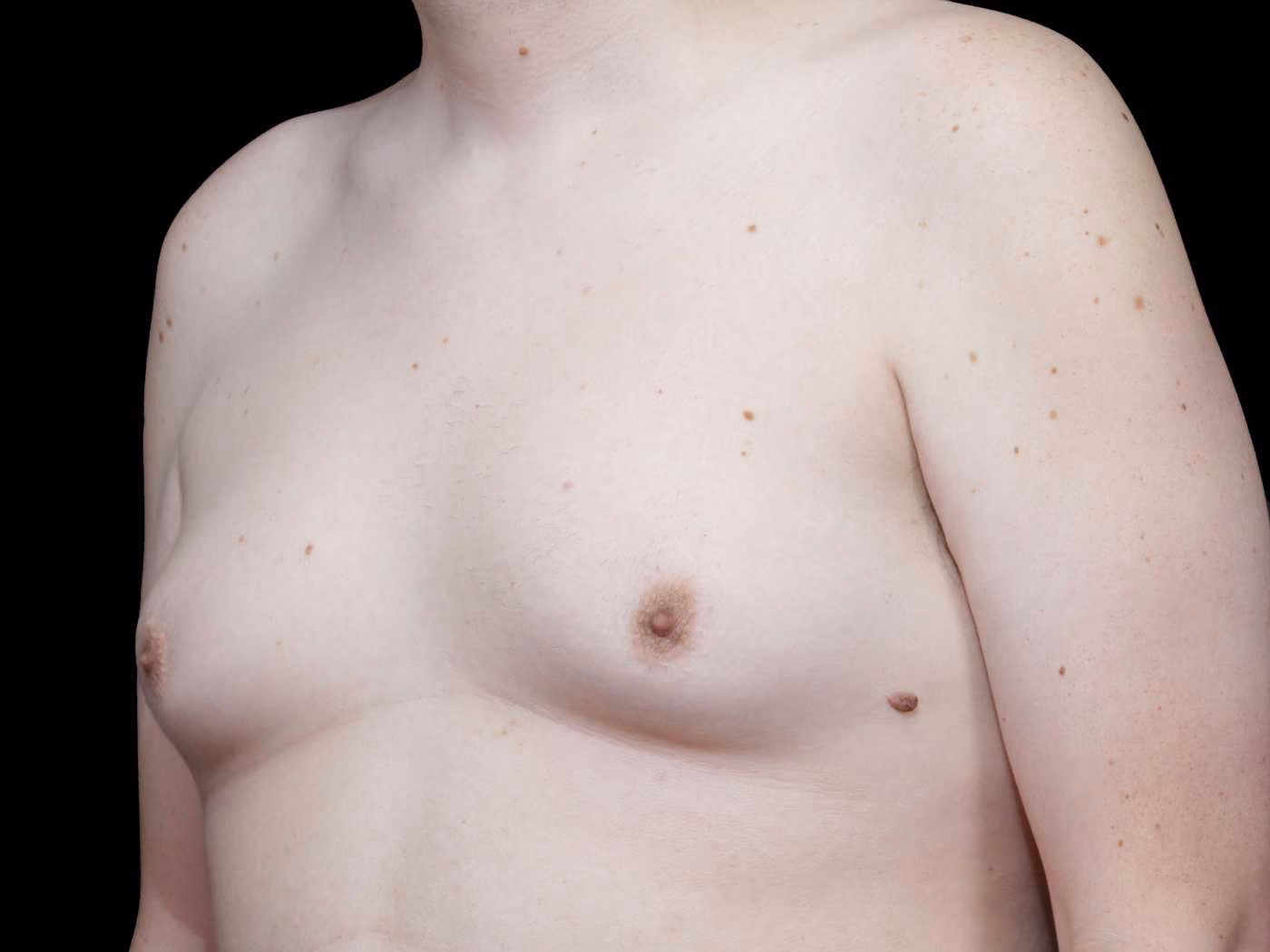 Gynecomastia Case 69