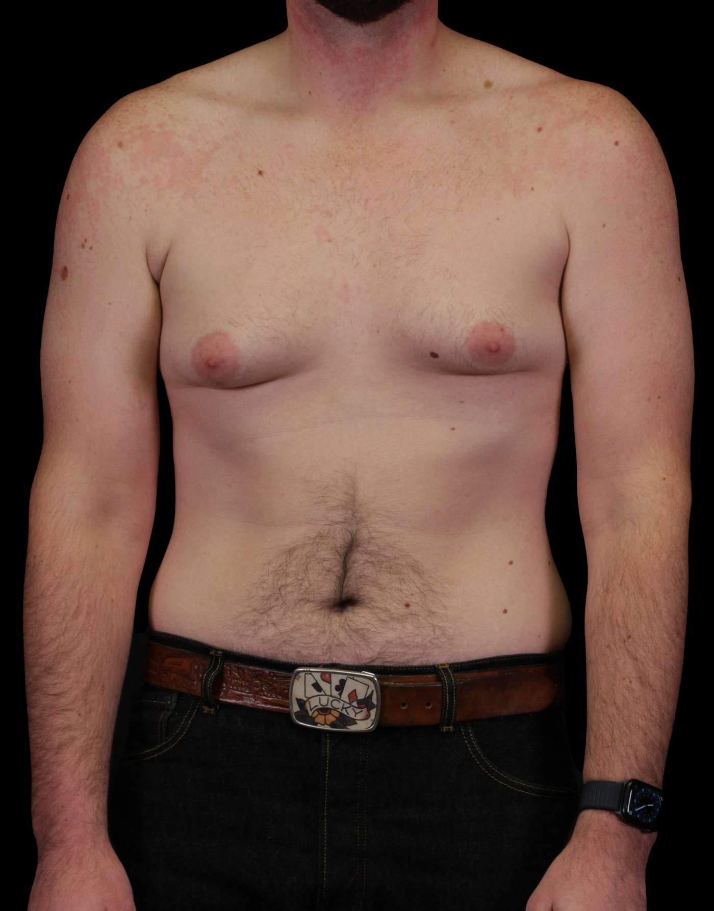 Gynecomastia Case 114