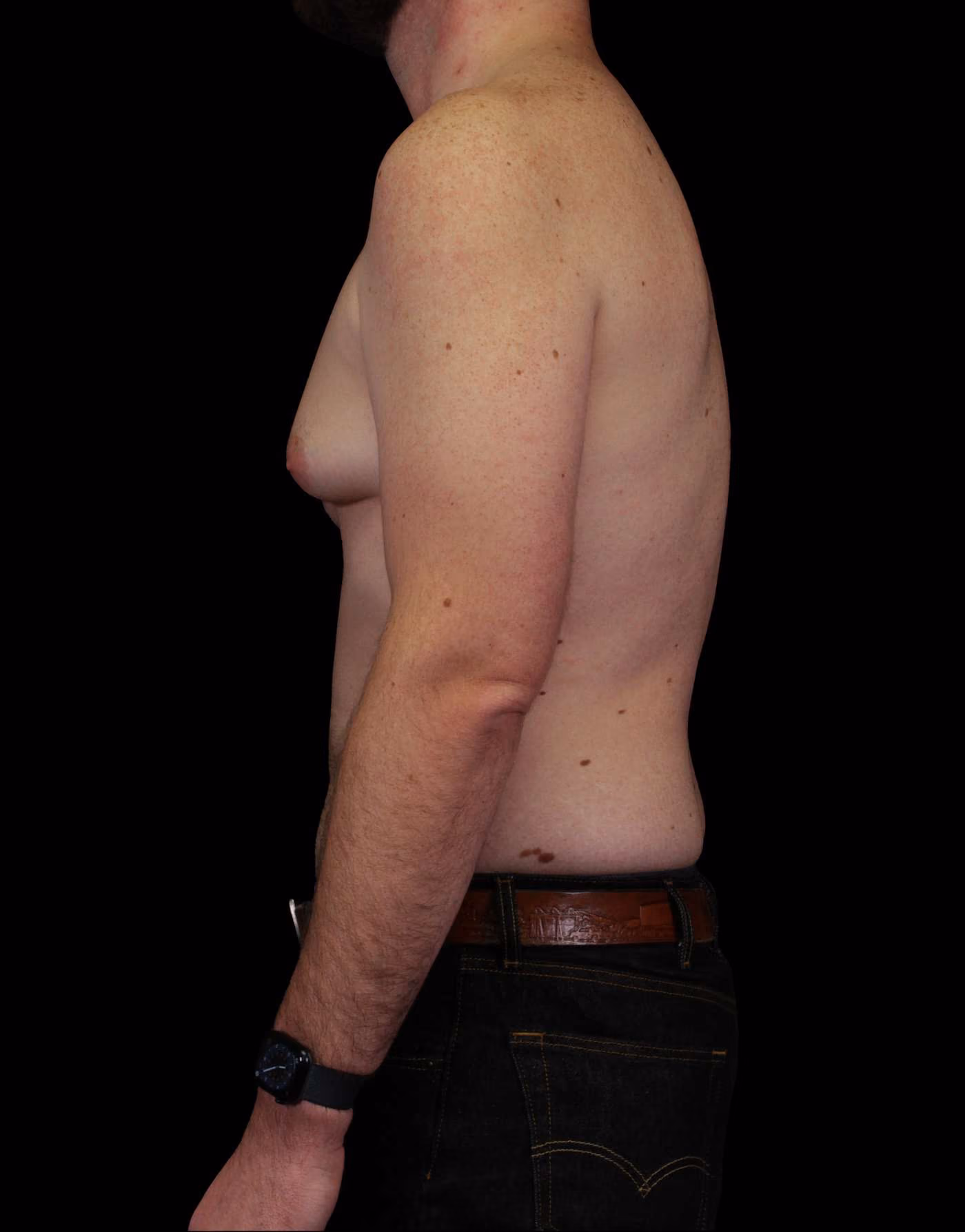 Gynecomastia Case 114