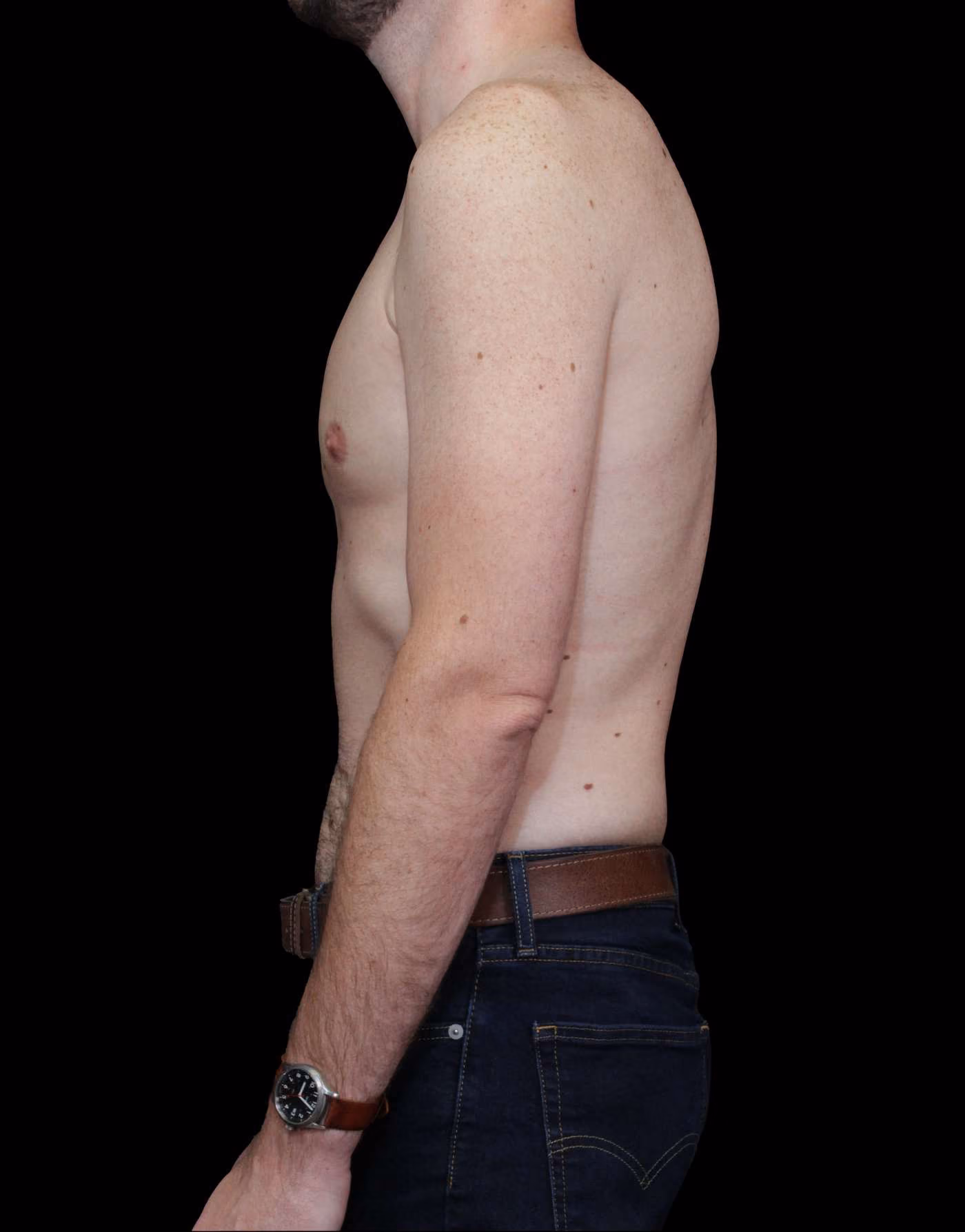 Gynecomastia Case 114