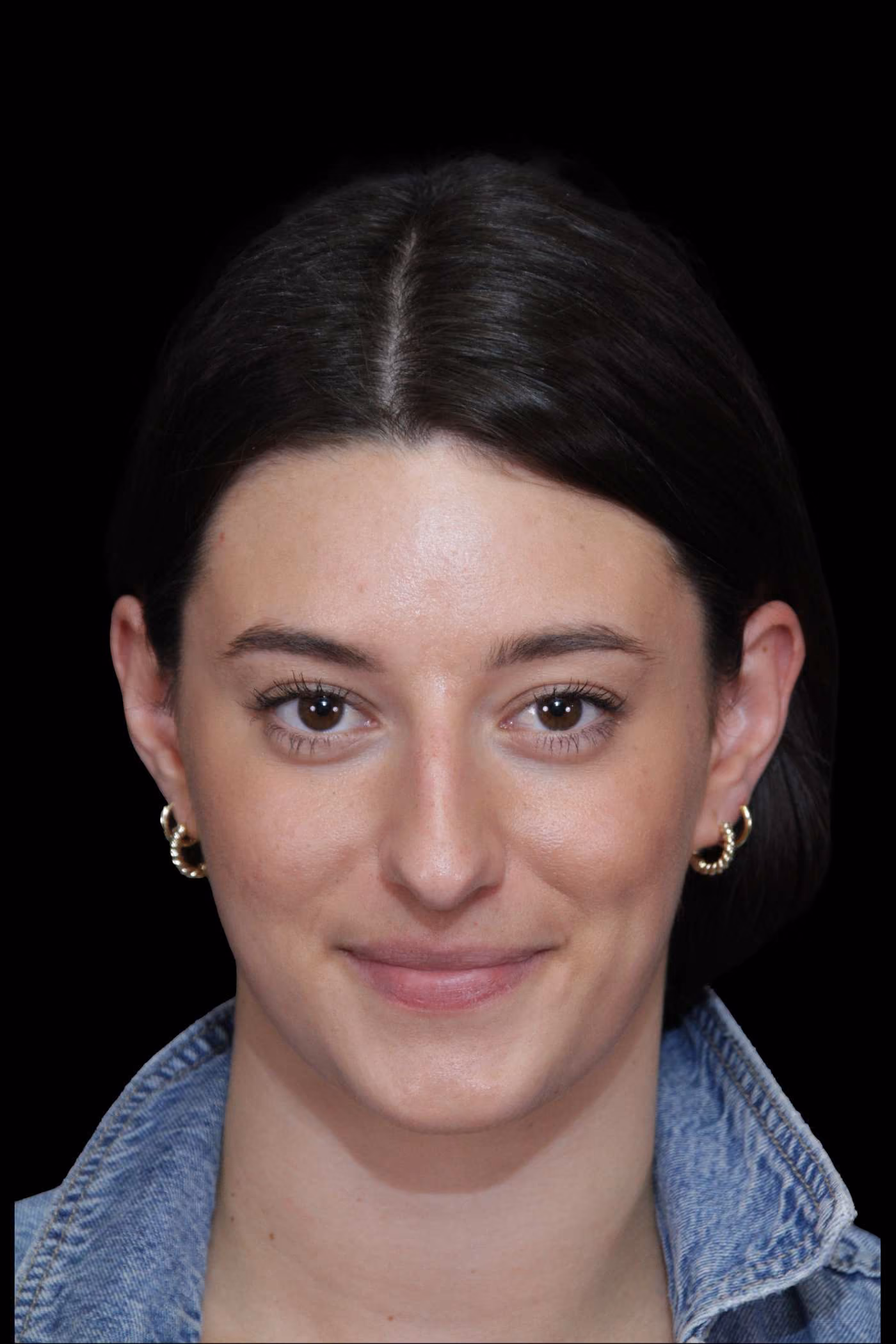 Rhinoplasty Case 72