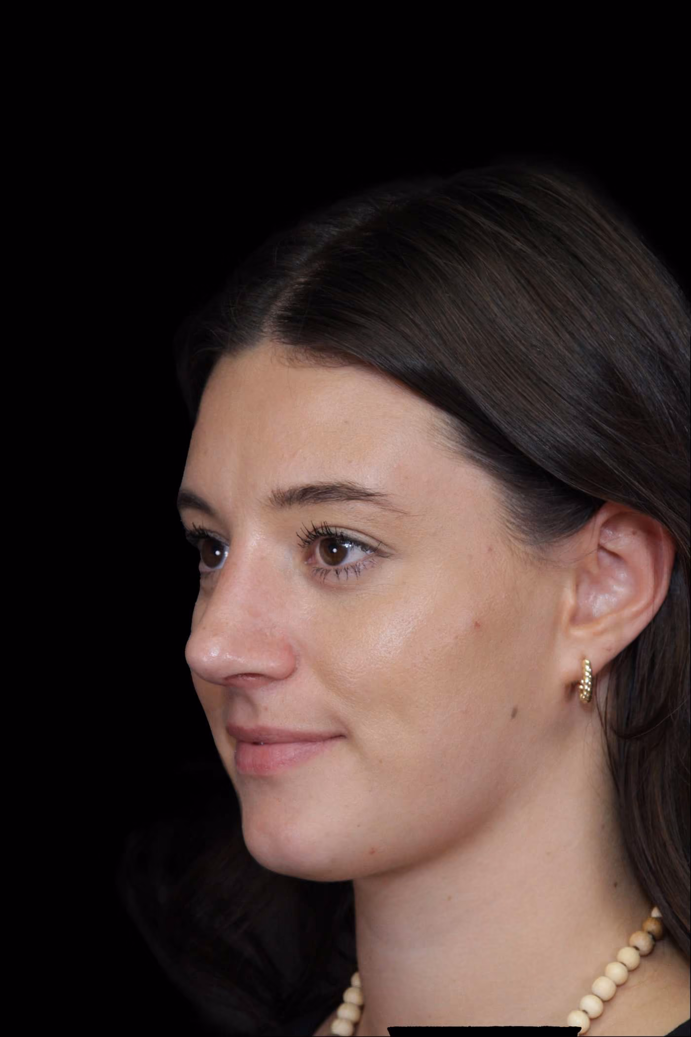 Rhinoplasty Case 72