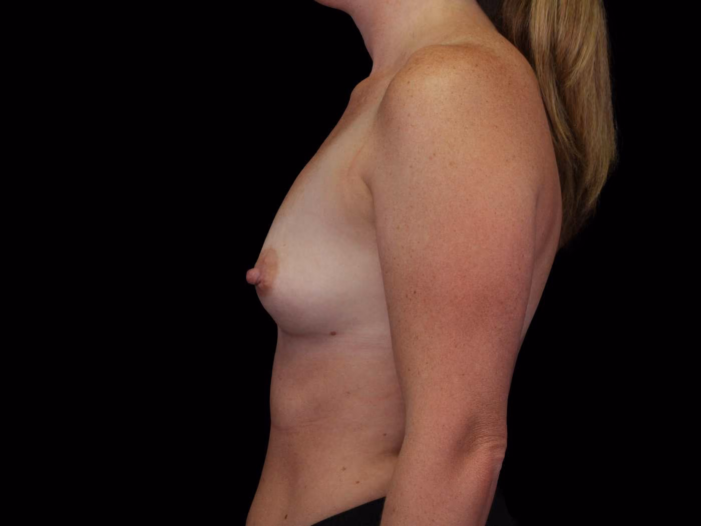 Breast Augmentation Case 84