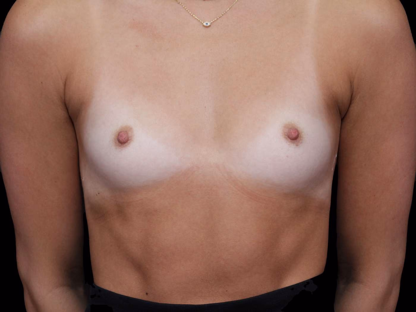 Breast Augmentation Case 89