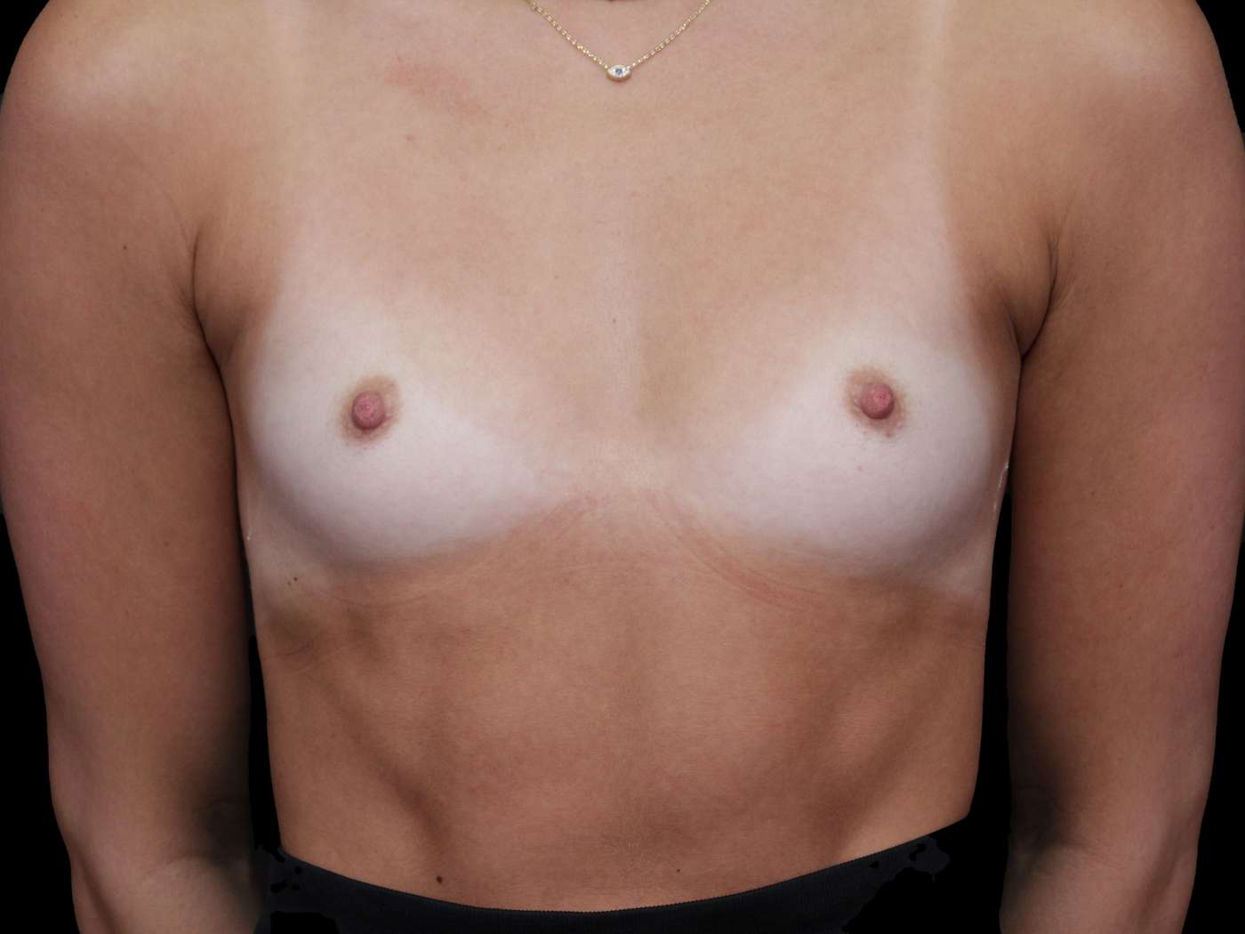 Breast Augmentation Case 89