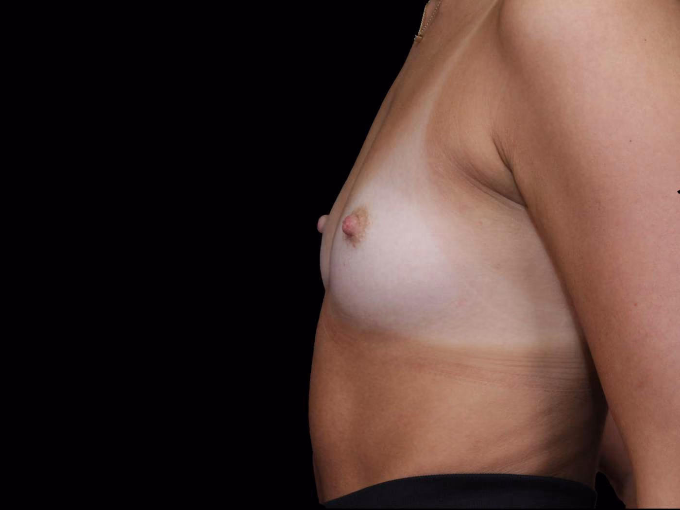 Breast Augmentation Case 89