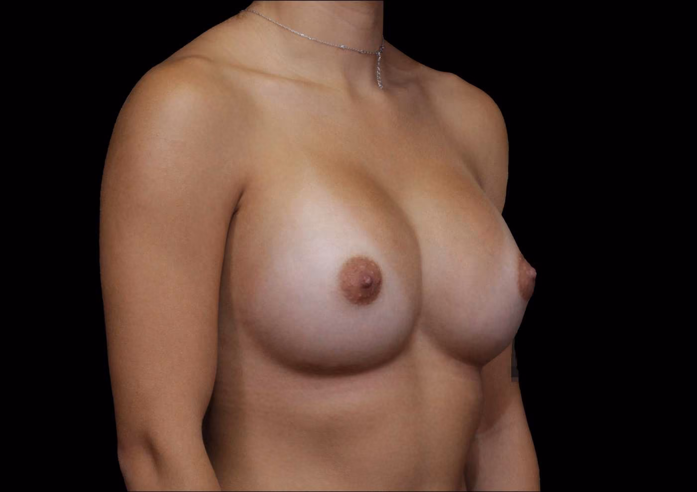 Breast Augmentation Case 128
