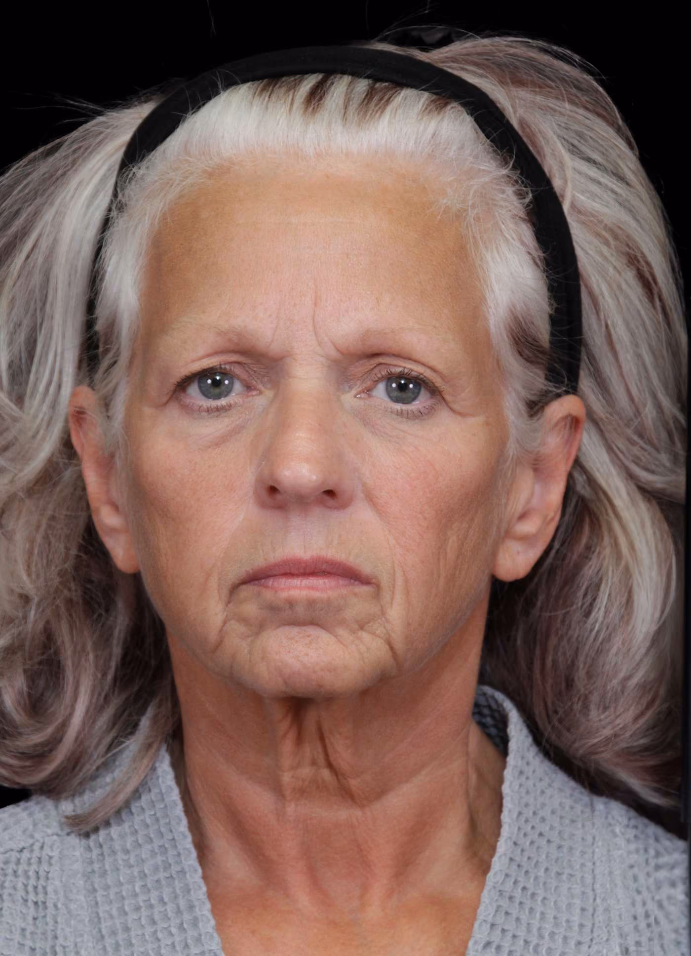 Upper & Lower Blepharoplasty Case 104
