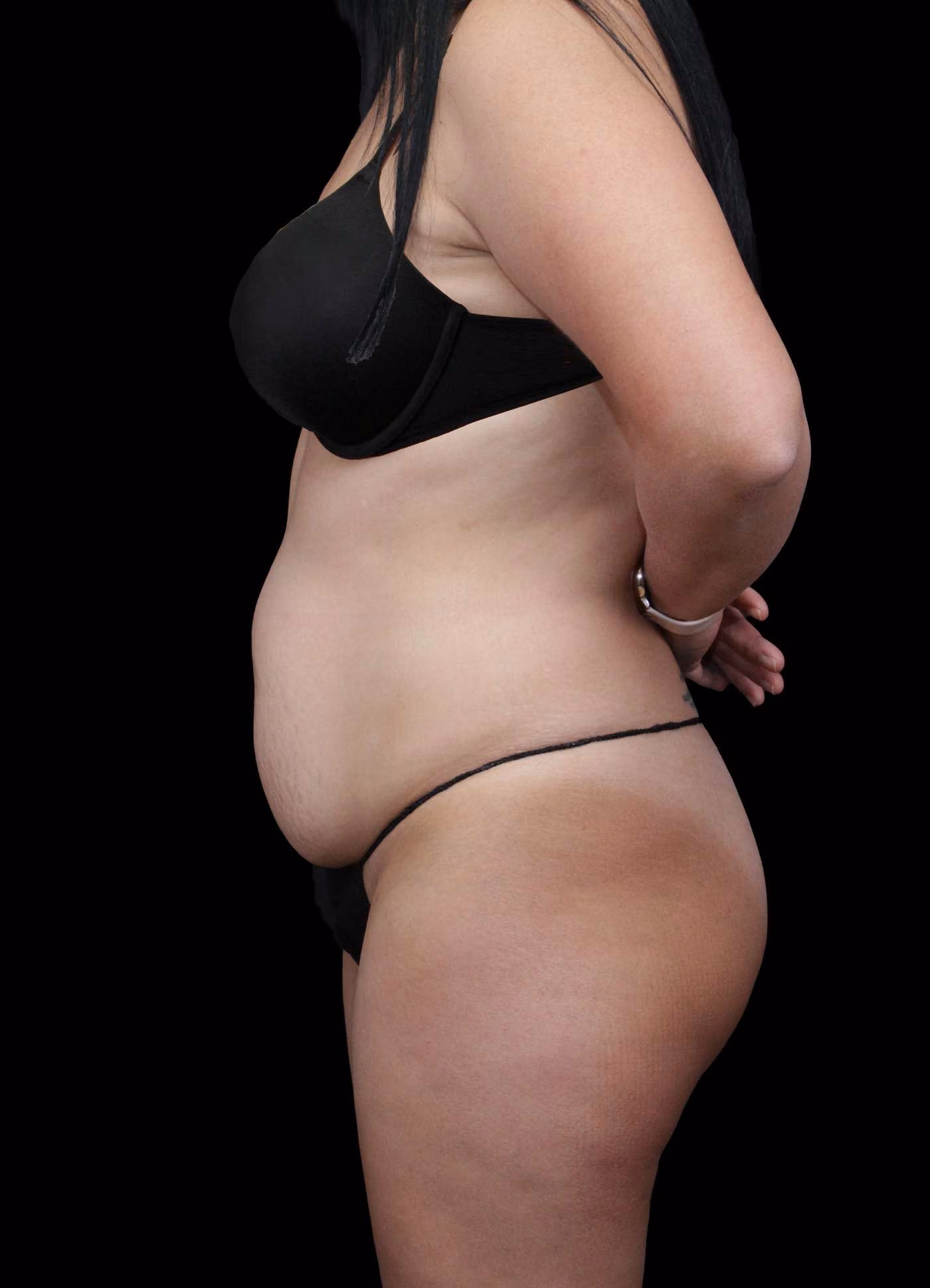 Abdominoplasty Case 116