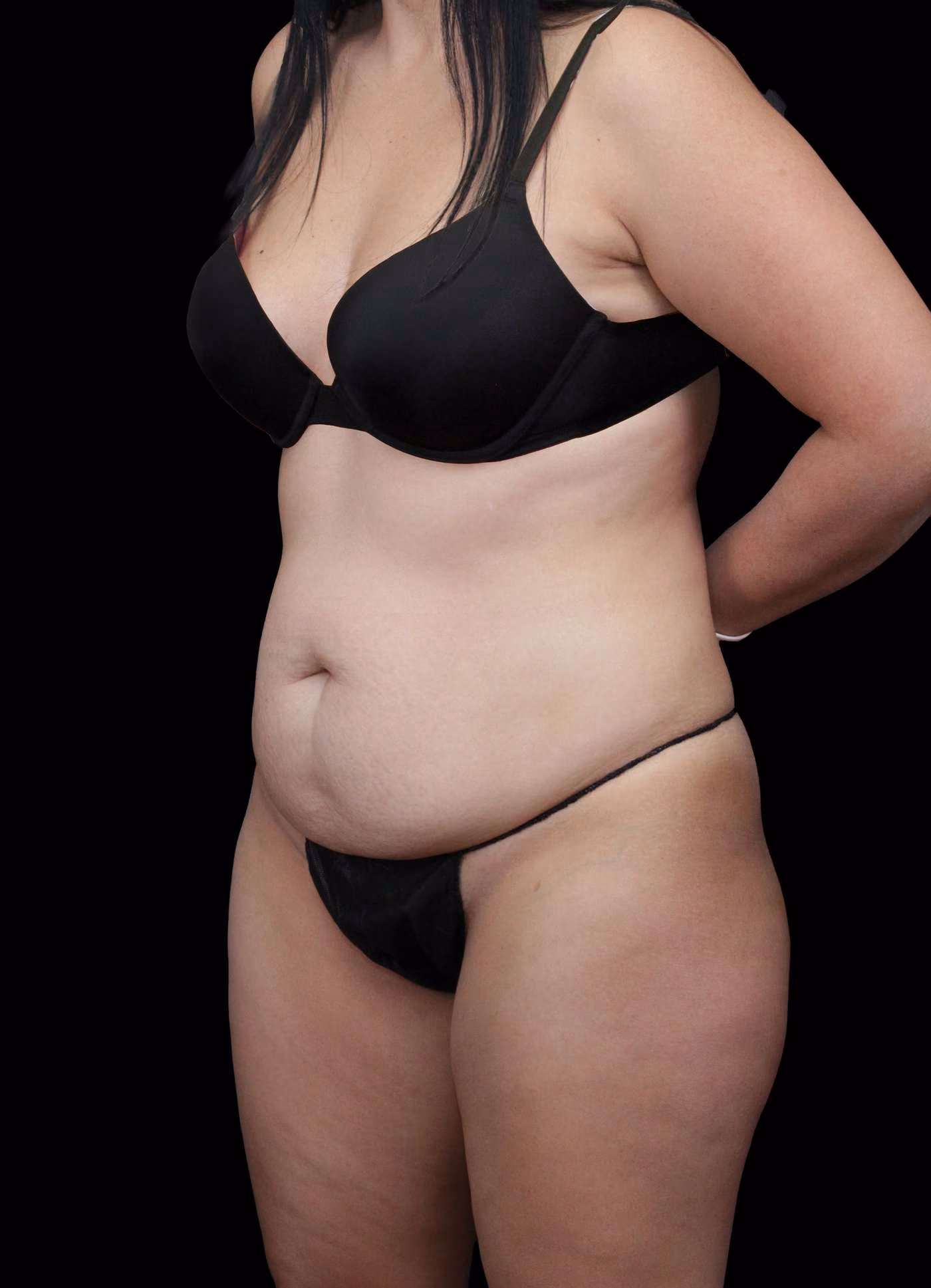 Abdominoplasty Case 116